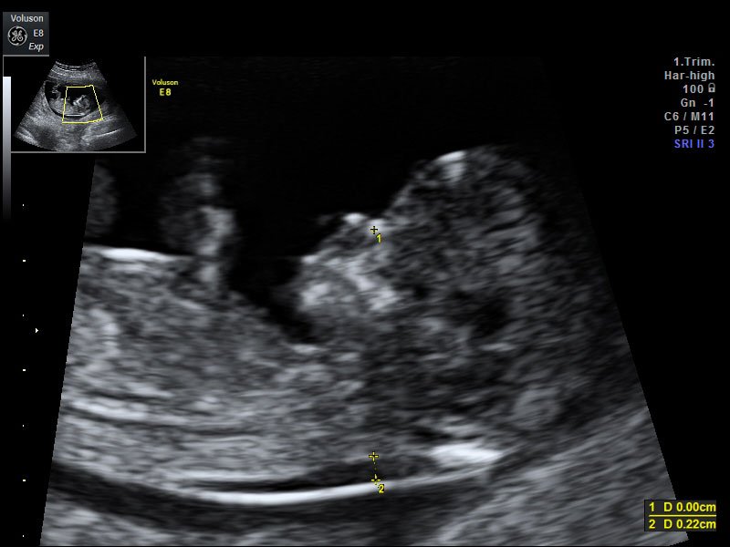NUCHAL 45