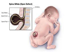 Spina bifida 2