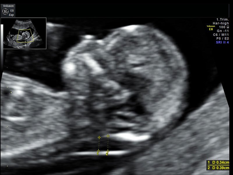 TRISOMIA 21