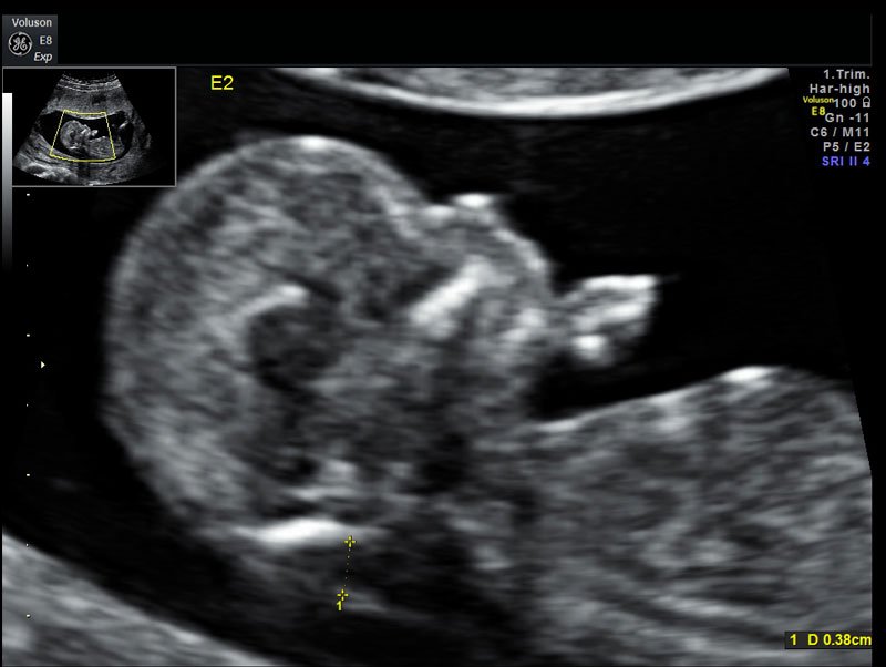 TRISOMIA 21 1