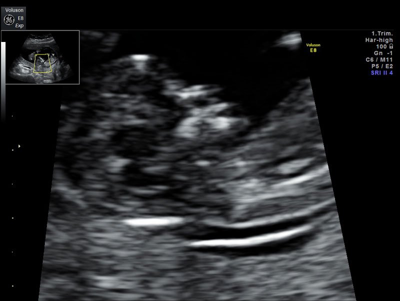 trisomia 21 1