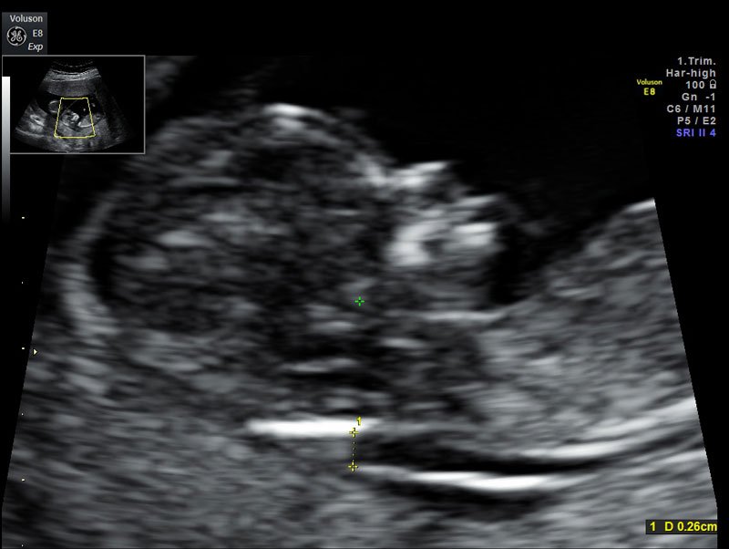 trisomia 21 2