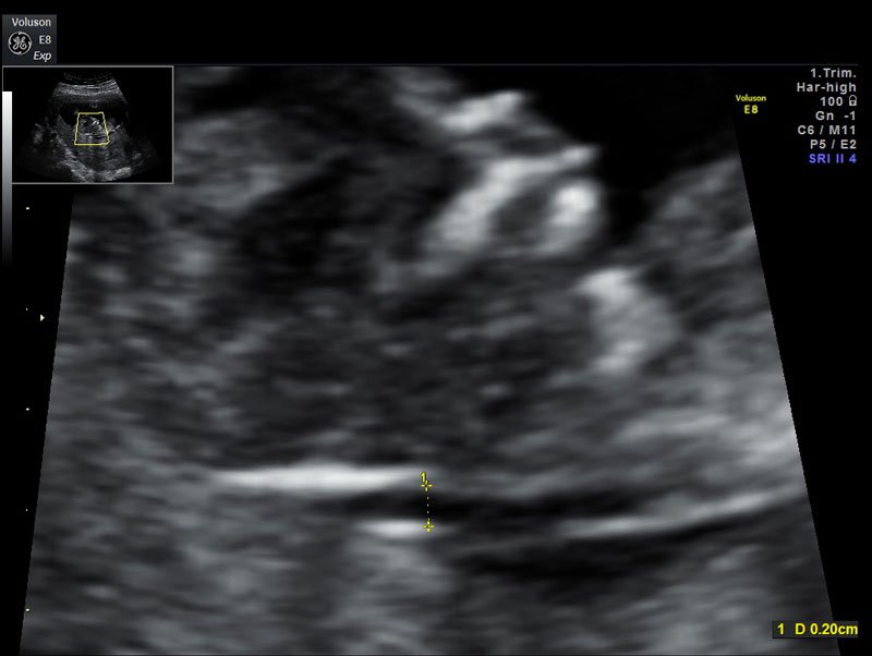 trisomia 21 3
