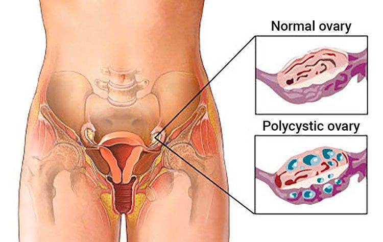Πολυκυστικές ωοθήκες {PCOS}