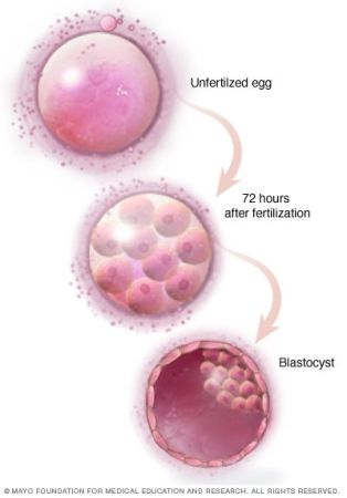 Εξωσωματική γονιμοποίηση (in –vitro fertilization-IVF)
