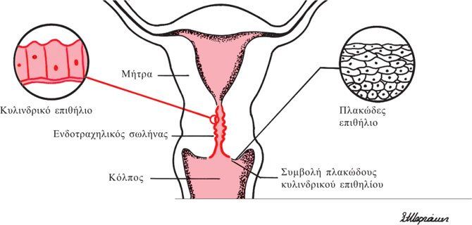 Φλεγμονώδεις παθήσεις κόλπου