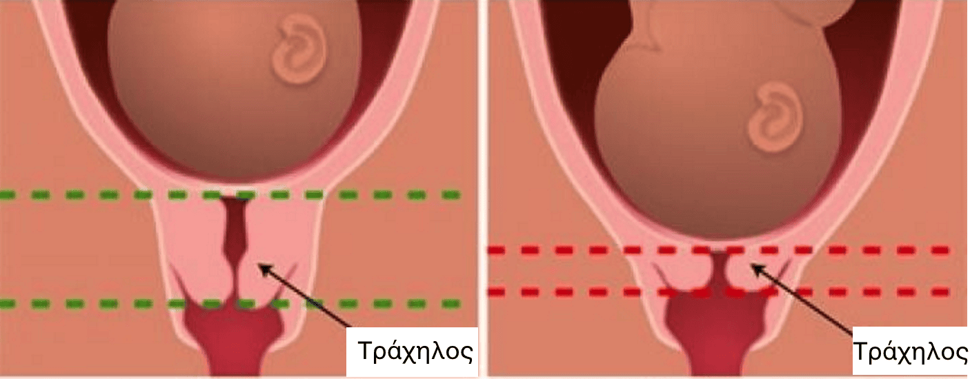 Βραχύς Τράχηλος και Πρόωρος Τοκετός