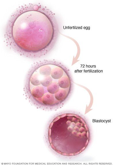 Εξωσωματική γονιμοποίηση (in –vitro fertilization-IVF)